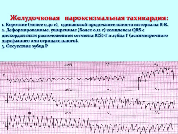 Желудочковая пароксизмальная тахикардия: 1. Короткие (менее 0,40 с), одинаковой продолжительности интервалы