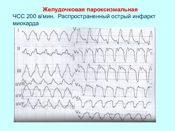Желудочковая пароксизмальная ЧСС 200 в/мин. Распространенный острый инфаркт миокарда