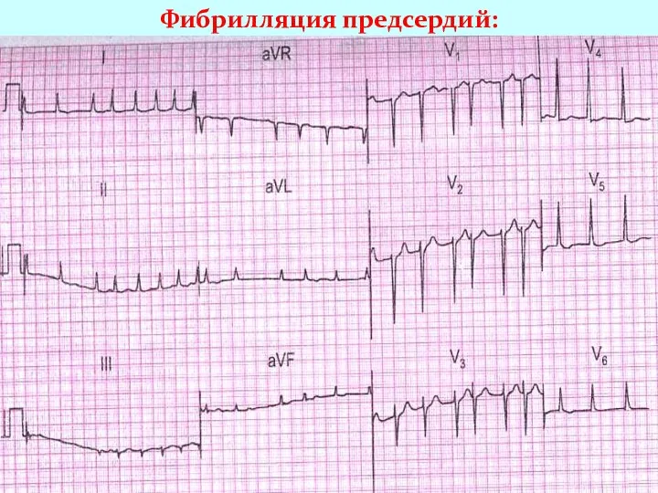 Фибрилляция предсердий: