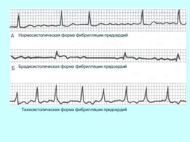Нормосистолическая форма фибрилляции предсердий Брадисистолическая форма фибрилляции предсердий Тахисистолическая форма фибрилляции предсердий