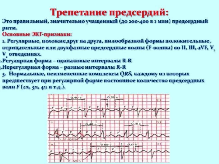 Трепетание предсердий: Это правильный, значительно учащенный (до 200-400 в 1 мин)