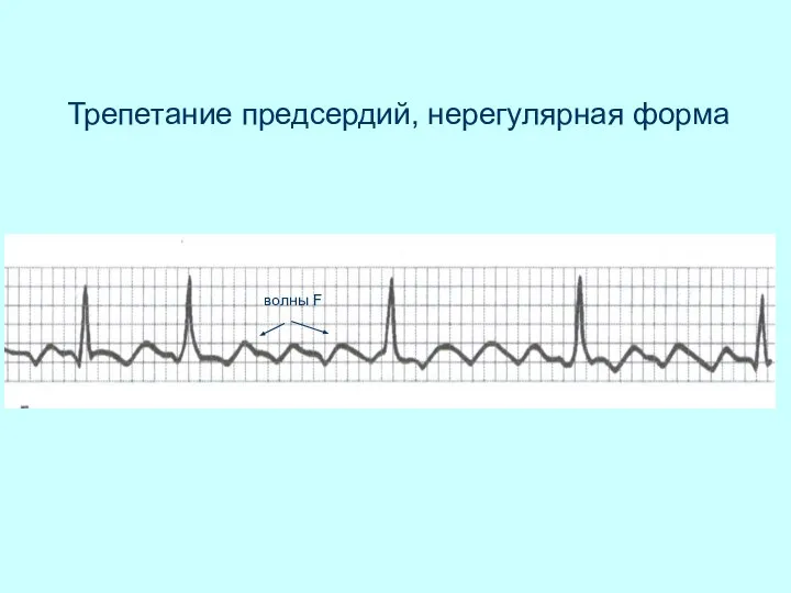 Трепетание предсердий, нерегулярная форма волны F