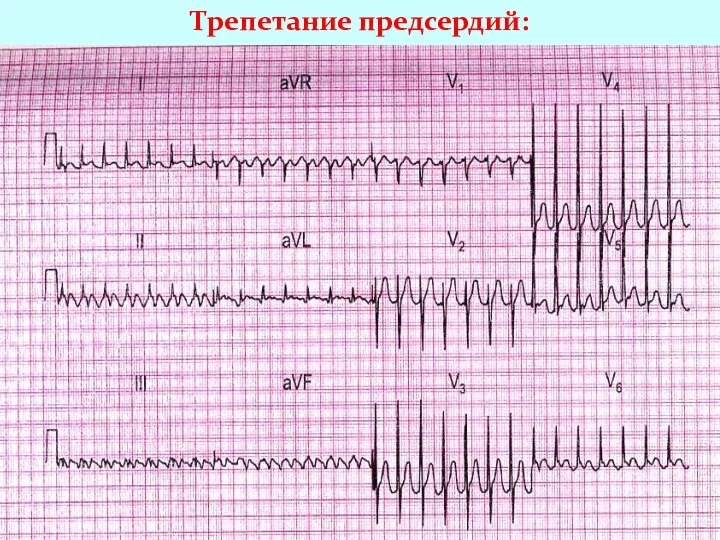 Трепетание предсердий: