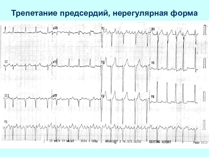 Трепетание предсердий, нерегулярная форма