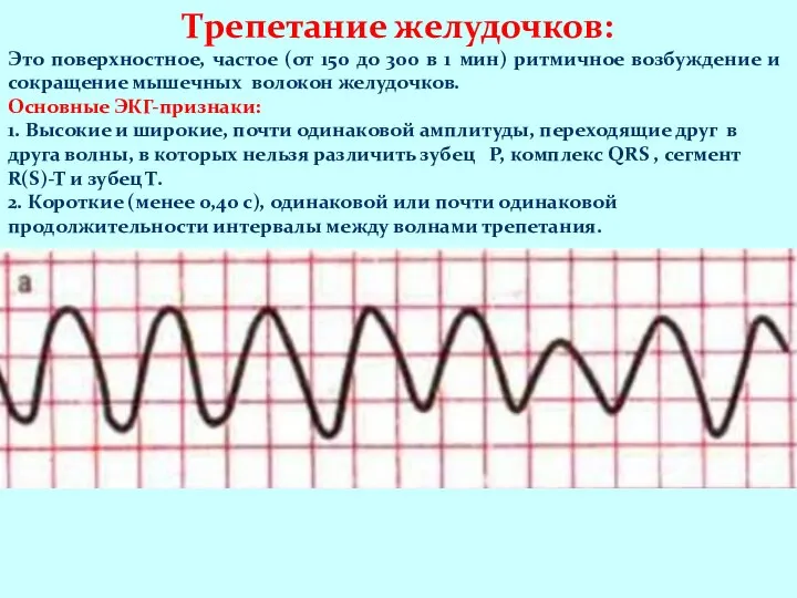 Трепетание желудочков: Это поверхностное, частое (от 150 до 300 в 1