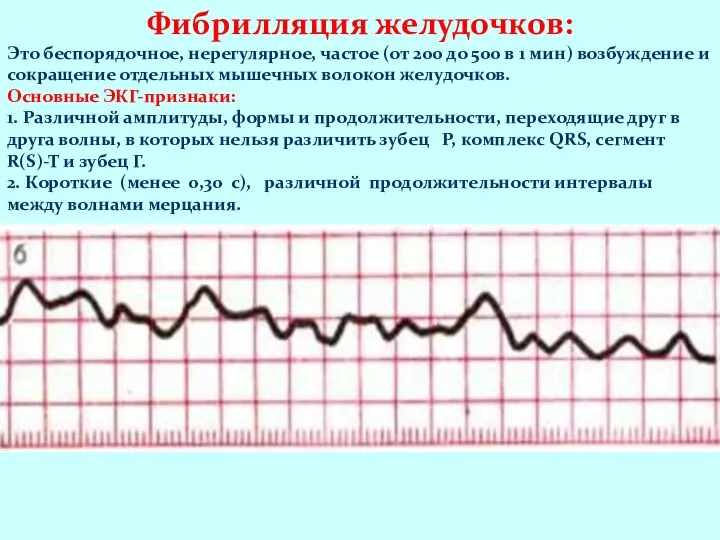 Фибрилляция желудочков: Это беспорядочное, нерегулярное, частое (от 200 до 500 в