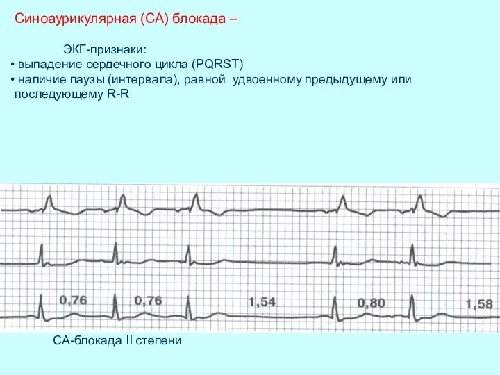 Синоаурикулярная (СА) блокада – ЭКГ-признаки: выпадение сердечного цикла (PQRST) наличие паузы