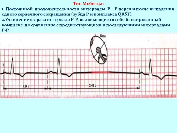 Тип Мобитца: 1. Постоянной продолжительности интервалы Р—Р перед и после выпадения