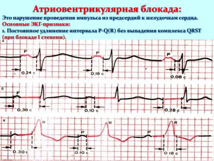 Атриовентрикулярная блокада: Это нарушение проведения импульса из предсердий к желудочкам сердца.