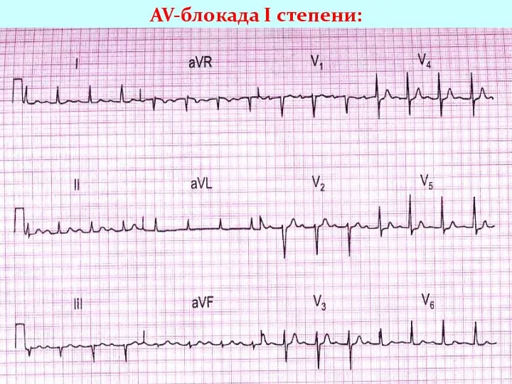 AV-блокада I степени: