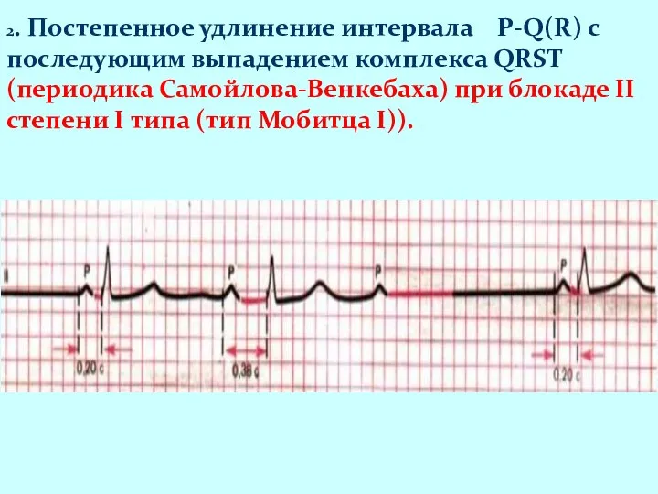 2. Постепенное удлинение интервала P-Q(R) с последующим выпадением комплекса QRST (периодика