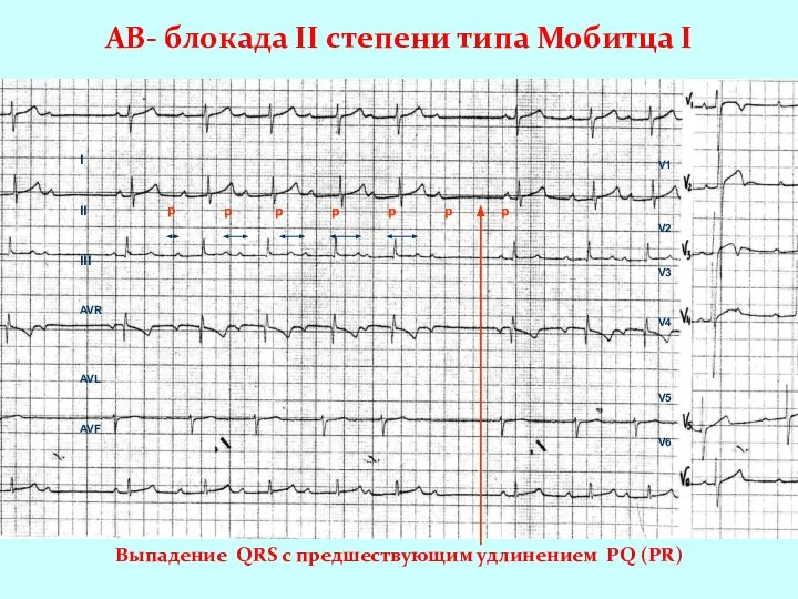 AВ- блокада II степени типа Мобитца I I II III AVR