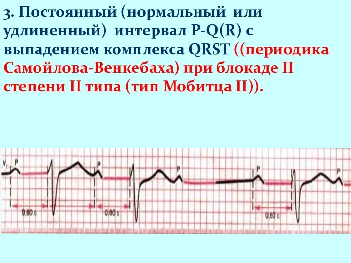 3. Постоянный (нормальный или удлиненный) интервал P-Q(R) с выпадением комплекса QRST