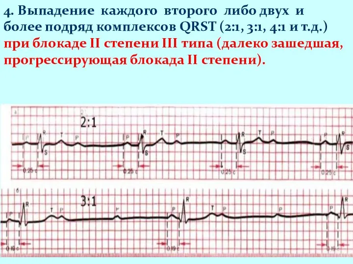 4. Выпадение каждого второго либо двух и более подряд комплексов QRST