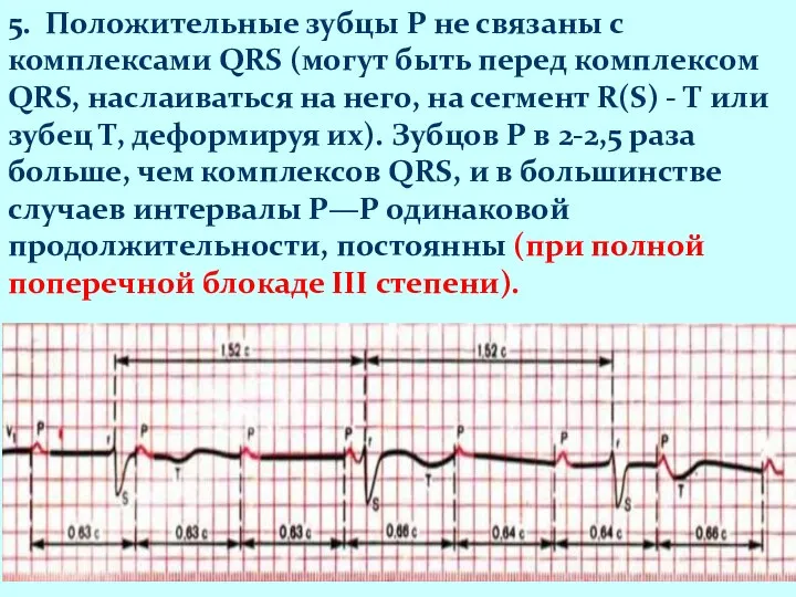 5. Положительные зубцы Р не связаны с комплексами QRS (могут быть