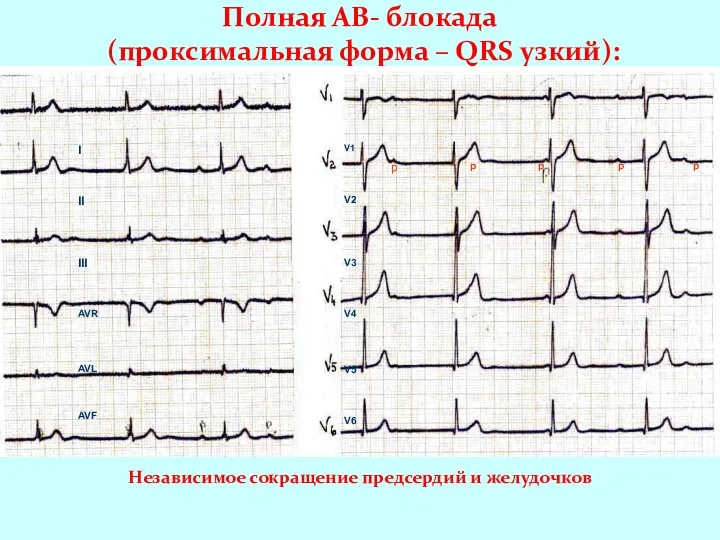 Полная АВ- блокада (проксимальная форма – QRS узкий): I II III