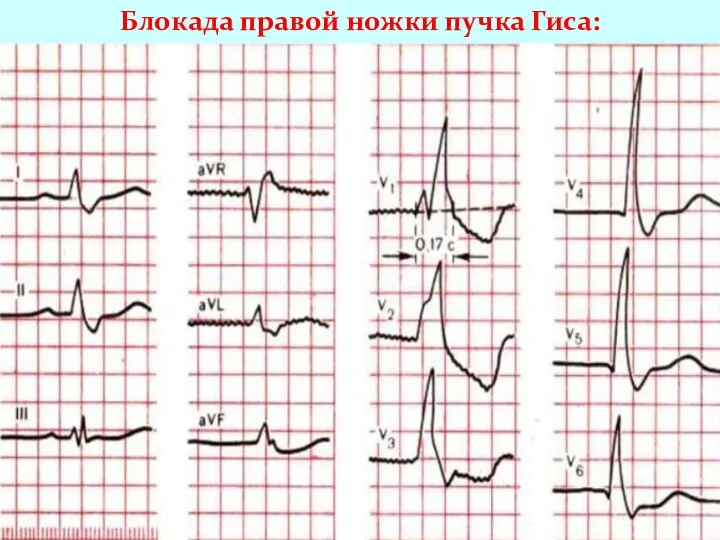 Блокада правой ножки пучка Гиса: