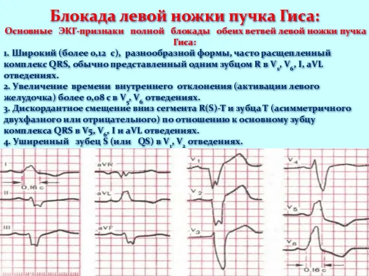 Блокада левой ножки пучка Гиса: Основные ЭКГ-признаки полной блокады обеих ветвей