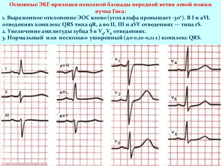 Основные ЭКГ-признаки неполной блокады передней ветви левой ножки пучка Гиса: 1.