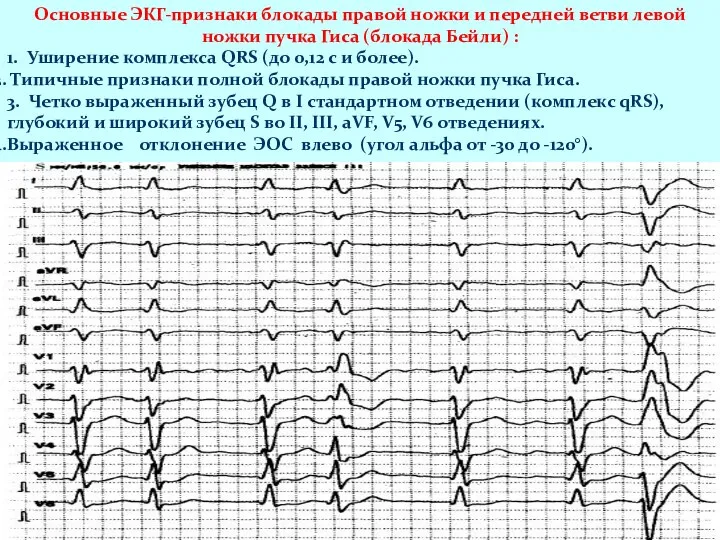 Основные ЭКГ-признаки блокады правой ножки и передней ветви левой ножки пучка