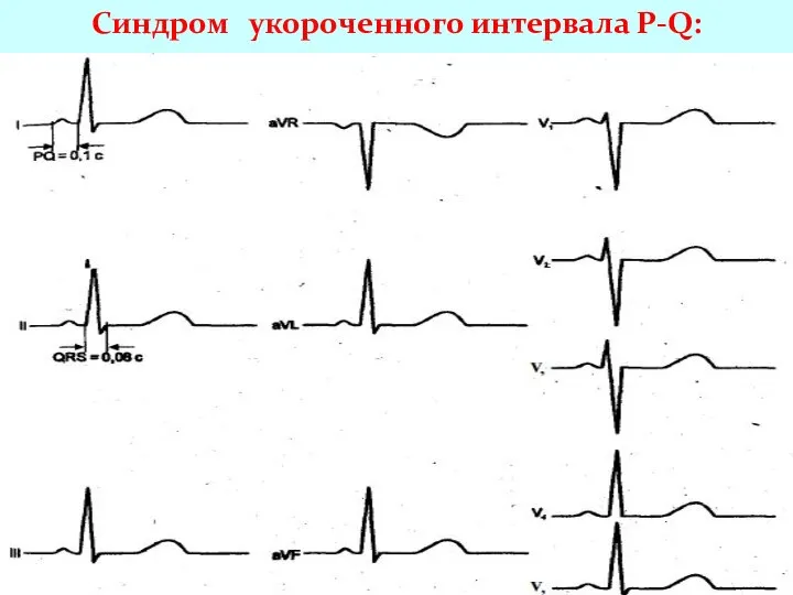 Синдром укороченного интервала P-Q: