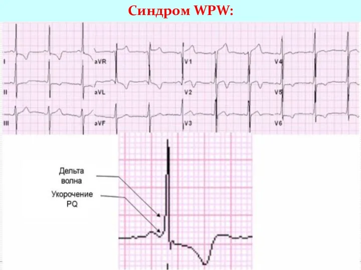 Синдром WPW:
