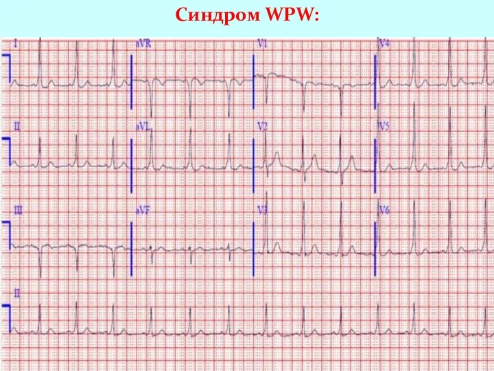 Синдром WPW: