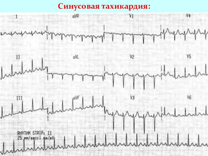 Синусовая тахикардия: