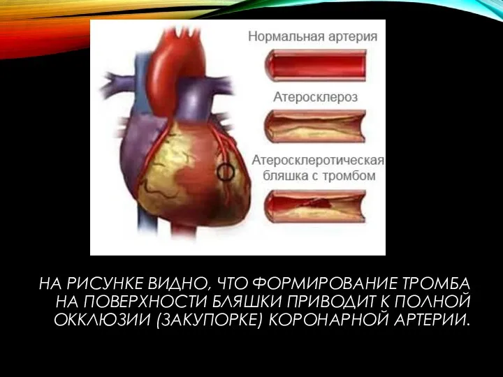 НА РИСУНКЕ ВИДНО, ЧТО ФОРМИРОВАНИЕ ТРОМБА НА ПОВЕРХНОСТИ БЛЯШКИ ПРИВОДИТ К ПОЛНОЙ ОККЛЮЗИИ (ЗАКУПОРКЕ) КОРОНАРНОЙ АРТЕРИИ.