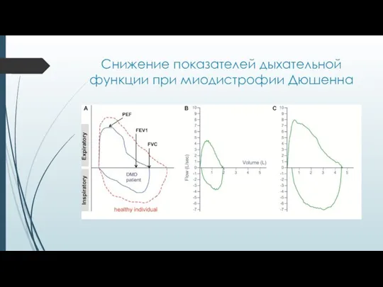 Снижение показателей дыхательной функции при миодистрофии Дюшенна