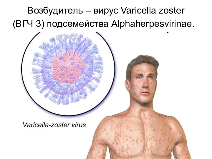 Возбудитель – вирус Varicella zoster (ВГЧ 3) подсемейства Alphaherpesvirinae.