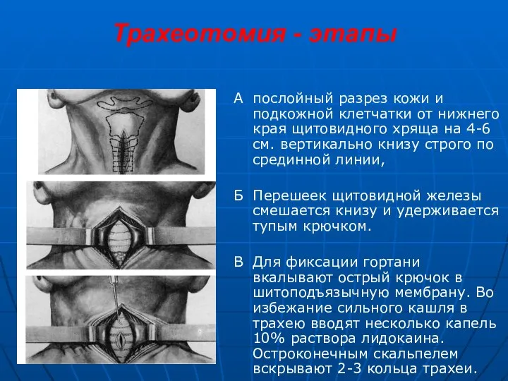 Трахеотомия - этапы А послойный разрез кожи и подкожной клетчатки от