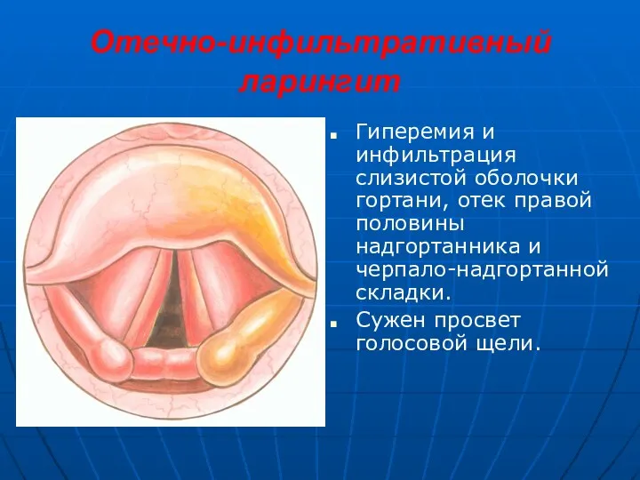 Отечно-инфильтративный ларингит Гиперемия и инфильтрация слизистой оболочки гортани, отек правой половины