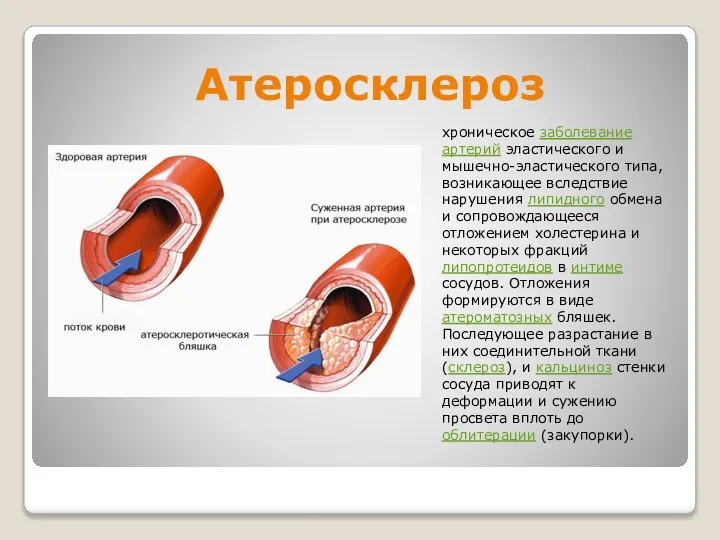 Атеросклероз хроническое заболевание артерий эластического и мышечно-эластического типа, возникающее вследствие нарушения