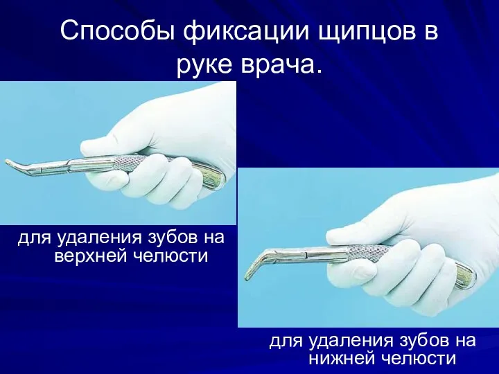 Способы фиксации щипцов в руке врача. для удаления зубов на верхней