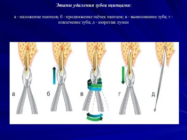 Этапы удаления зубов щипцами: а - наложение щипцов; б - продвижение