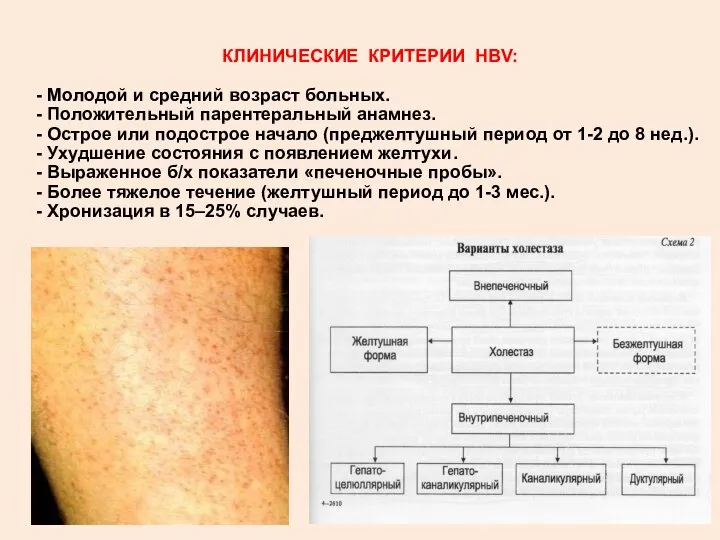 КЛИНИЧЕСКИЕ КРИТЕРИИ HBV: - Молодой и средний возраст больных. - Положительный