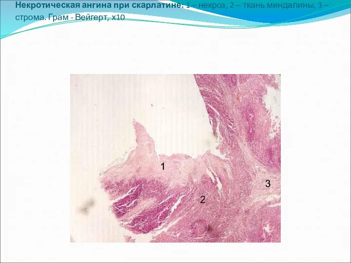 Некротическая ангина при скарлатине: 1 – некроз, 2 – ткань миндалины,