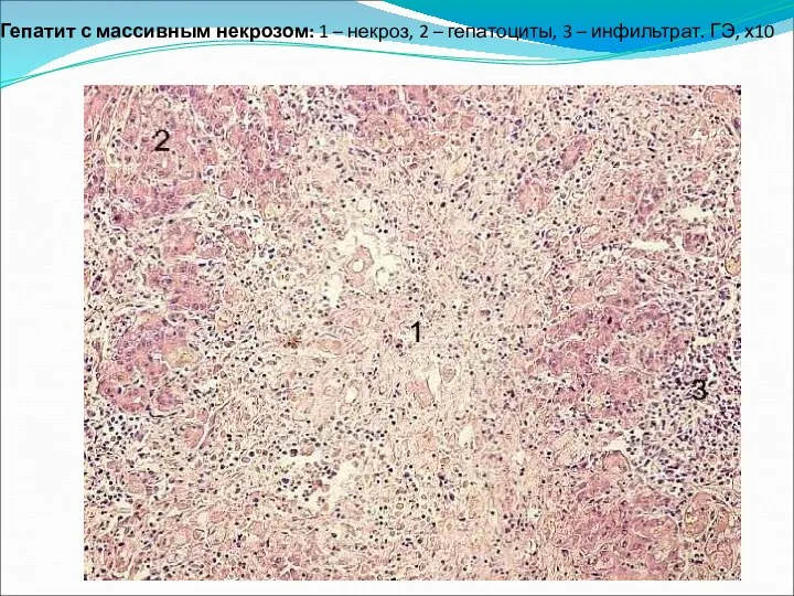 Гепатит с массивным некрозом: 1 – некроз, 2 – гепатоциты, 3 – инфильтрат. ГЭ, х10