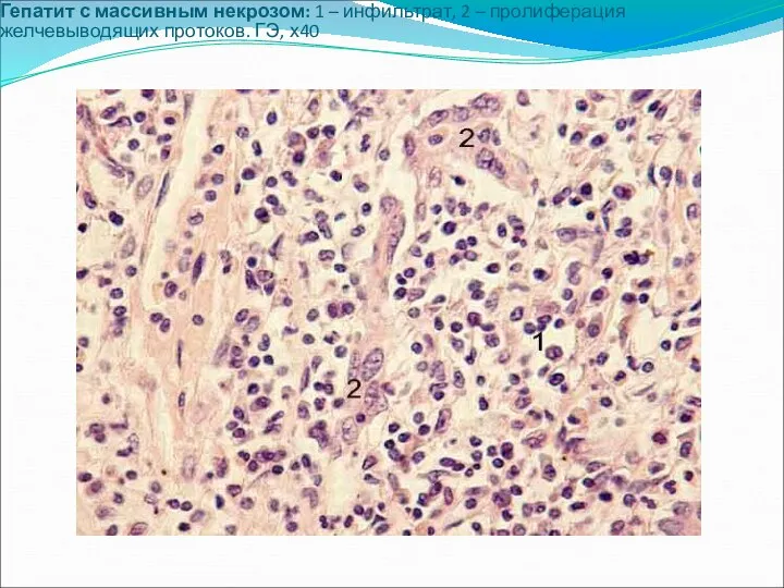Гепатит с массивным некрозом: 1 – инфильтрат, 2 – пролиферация желчевыводящих протоков. ГЭ, х40