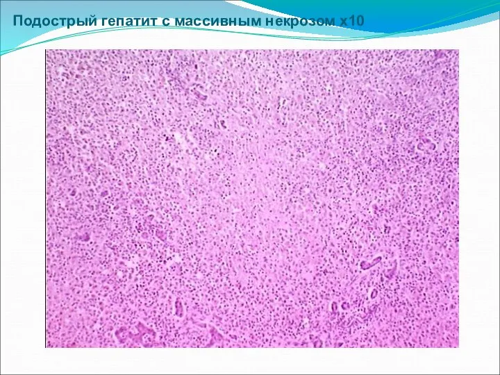 Подострый гепатит с массивным некрозом х10