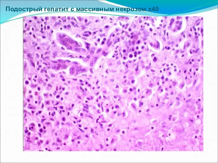 Подострый гепатит с массивным некрозом х40