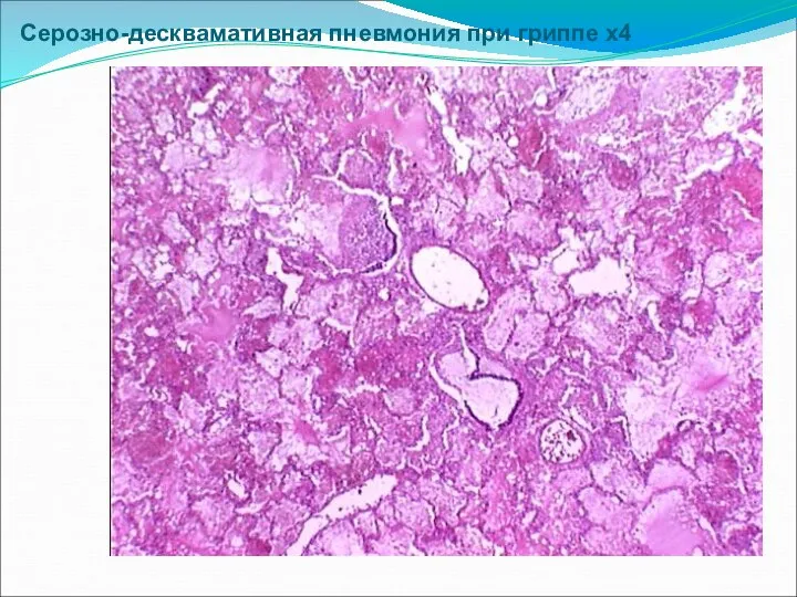 Серозно-десквамативная пневмония при гриппе х4