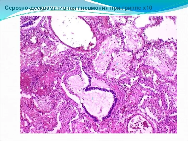 Серозно-десквамативная пневмония при гриппе х10