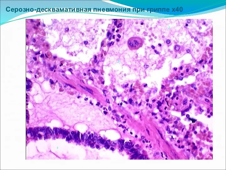 Серозно-десквамативная пневмония при гриппе х40