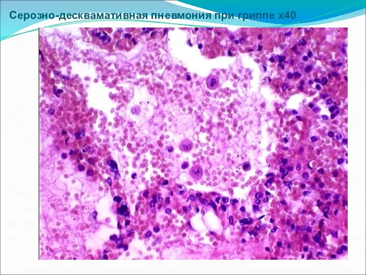 Серозно-десквамативная пневмония при гриппе х40