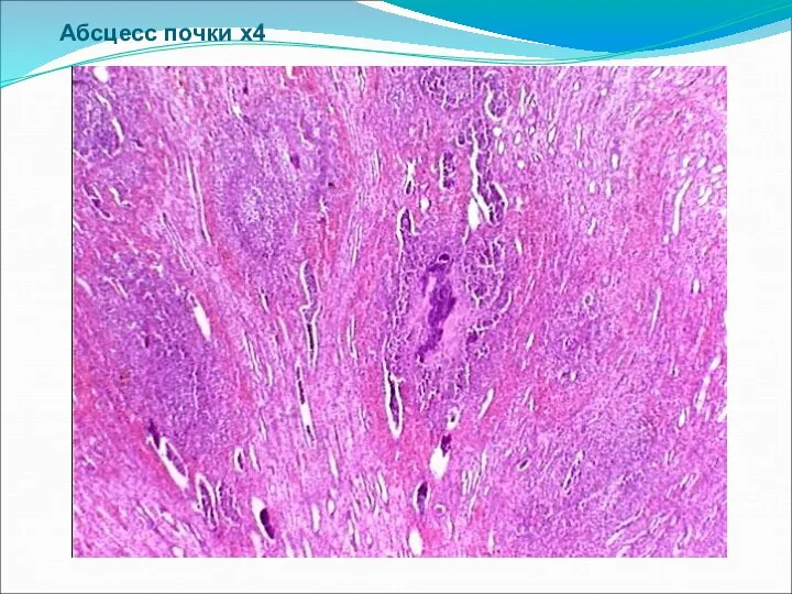 Абсцесс почки х4