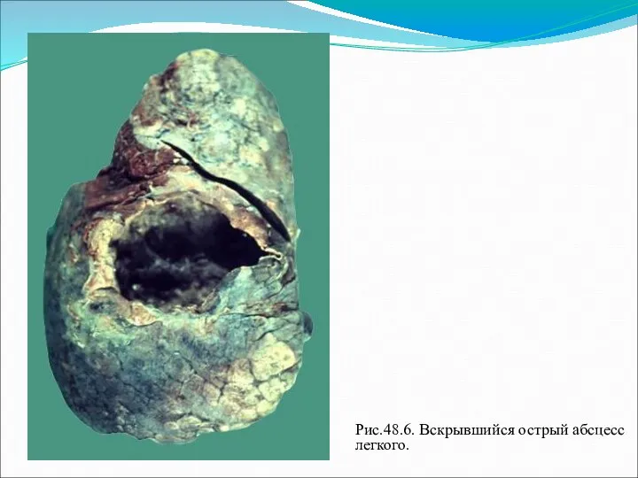 Рис.48.6. Вскрывшийся острый абсцесс легкого.