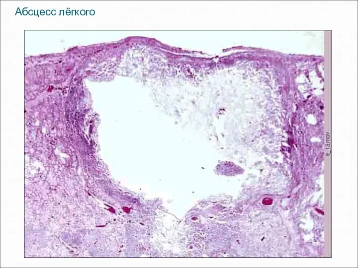 Абсцесс лёгкого