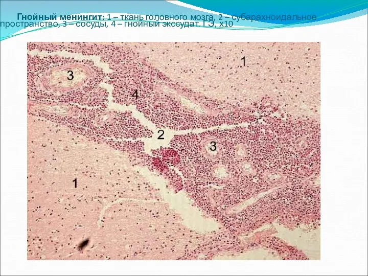 Гнойный менингит: 1 – ткань головного мозга, 2 – субарахноидальное пространство,